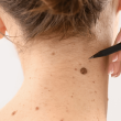 SKIN TAG MOLE REMOVAL